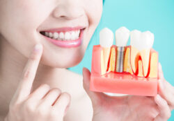 Entretenir les implants dentaires